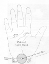 Laser Acupuncture for Carpal Tunnel Syndrome and Hand Spasticity
